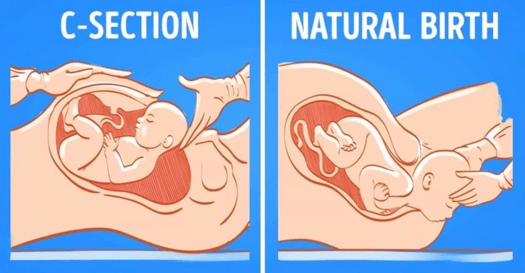 Cesarean vs. Vaginal Birth? A Detailed Comparison and Guide to Informed&nbsp;Decision-Making